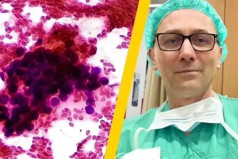 Mikroskopowy obraz komórek nowotworowych, które mogą być jednymi z najzłośliwszych nowotworów, obok lekarza w zielonym fartuchu i czepku.