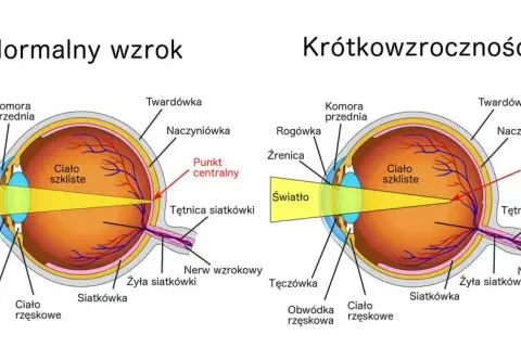 Krótkowzroczność: przyczyny, objawy i jak chronić wzrok?