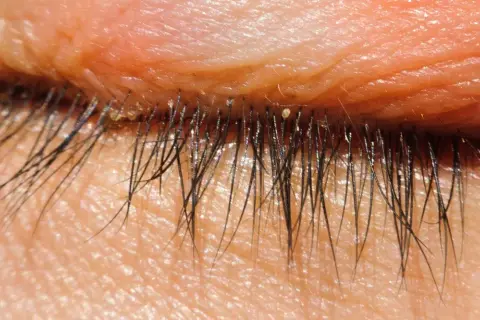 Nahaufnahme des menschlichen Augenlids mit Wimpern. Kleine, helle Punkte, die wie Milben am Auge aussehen, sind auf den Wimpern und der Haut sichtbar.