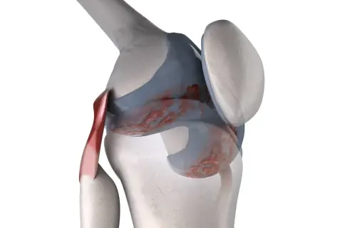 Dettaglio anatomico del ginocchio con lesioni cartilaginee e tendine rosso. Il ginocchio che scricchiola quando lo stendo potrebbe essere causato da questo.