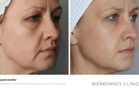 Przed i po zabiegu lipotransferu. Widoczne wygładzenie skóry i przywrócenie objętości twarzy.