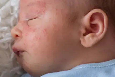 Alergia na BMK u niemowlaka: Objawy, które musisz znać!