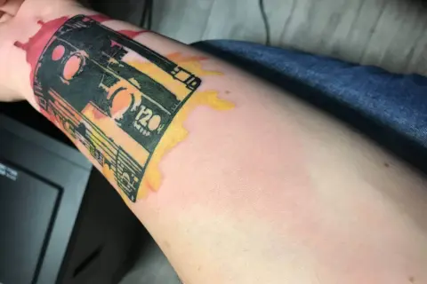 Ramię z tatuażem kasety magnetofonowej, widoczna opuchlizna po tatuazu i zaczerwienienie wokół.