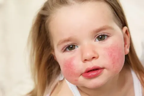 Alergia dziedziczna: Czy Twoje dziecko jest zagrożone?