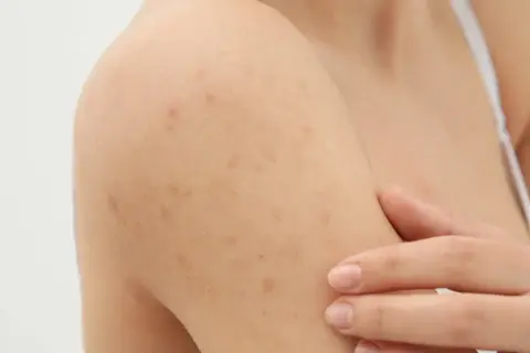 Widoczne grudki pod skórą na ramieniu, które mogą być objawem problemów dermatologicznych.
