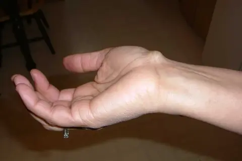 Poignet gauche avec un kyste synovial visible. Témoignages sur le kyste synovial poignet.