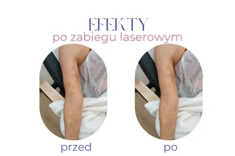 Przed i po zabiegu laserowym: widoczne ciemne blizny na nogach stają się jaśniejsze i mniej widoczne.