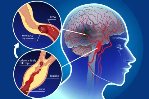 PFO objawy neurologiczne: Jak unikać ryzyka udaru mózgu?
