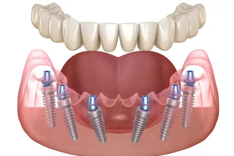 Implantes dentales all on six para una sonrisa completa y natural.