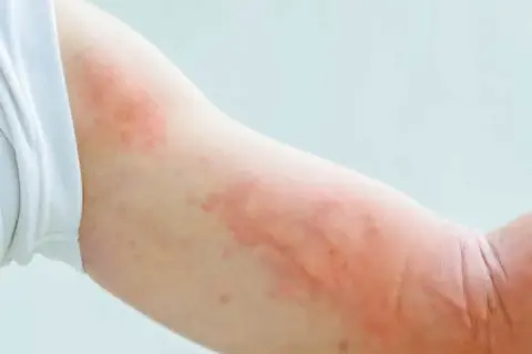 Widoczne czerwone plamy na ramieniu, prawdopodobnie objaw alergii lub pokrzywki.