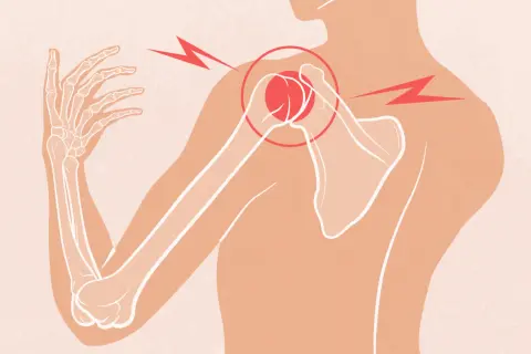 Douleur vive à l'épaule et au dos, le muscle tendu irradie. Le squelette de l'épaule est mis en évidence.