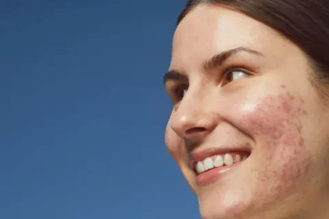 Sonrisa radiante de una joven con acné, buscando soluciones para quitar granos y lucir una piel sana.