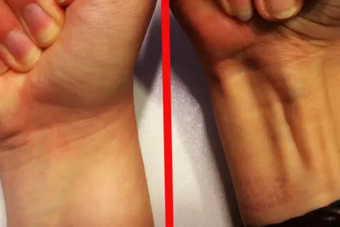 Vergleich zweier Handgelenke: Links glatt, rechts mit sichtbaren Sehnen, darunter der palmaris longus.