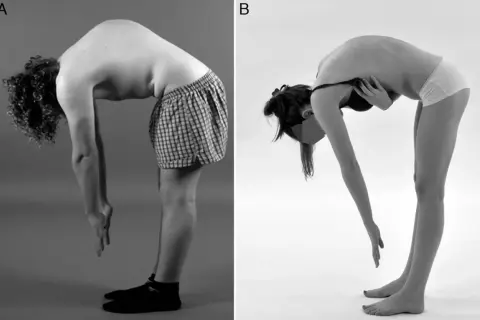 Deux individus se penchent en avant. L'image A montre une cyphose dorsale normale chez un homme. L'image B montre une posture similaire chez une femme.