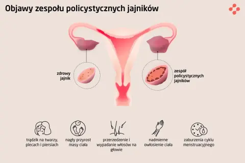 Ilustracja pokazuje budowę macicy i jajników, porównując zdrowy jajnik z tym dotkniętym PCOS. Widoczne są objawy: trądzik, przyrost masy ciała, wypadanie włosów, nadmierne owłosienie i zaburzenia cyklu.