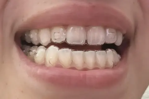 Denti con Invisalign, pronti per mangiare uno yogurt cremoso.