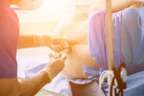 Un médico administra una epidural. Se discuten los posibles efectos secundarios de la epidural, como dolor de cabeza o entumecimiento.