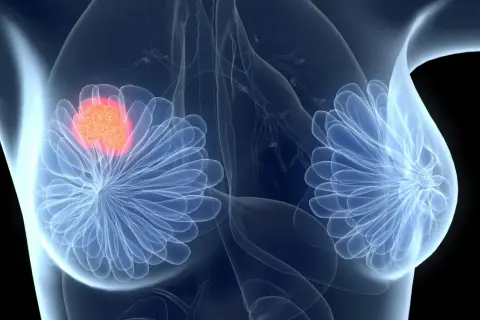 Brustkrebs-Tumor, der mit Ribociclib behandelt wird. Ribociclib ist eine Chemotherapie.