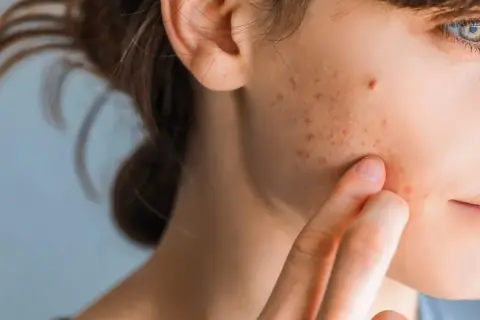 Nahaufnahme einer jungen Frau, die mit dem Finger über ihre Wange streicht, auf der rote und braune Flecken sichtbar sind, die auf Stresspickel hindeuten.