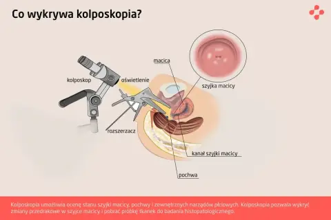 Ilustracja pokazuje, co to kolposkopia: badanie szyjki macicy kolposkopem, rozszerzaczem i oświetleniem.
