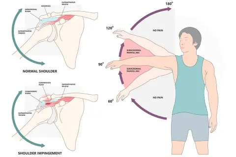 Schulter-Impingement-Syndrom: Schmerzhafter Bogen bei Armhebung zwischen 60° und 120°. Normale Schulter ohne Schmerz.