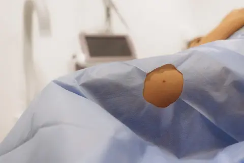 Skóra pacjenta przygotowana do zabiegu dermatochirurgii. W tle sprzęt medyczny.