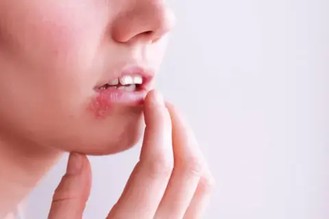 Z opryszczką do dentysty? Kiedy wizyta jest bezpieczna i co robić?