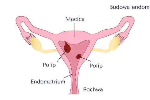 Schemat budowy macicy z widocznymi polipami w obrębie błony śluzowej macicy (endometrium).
