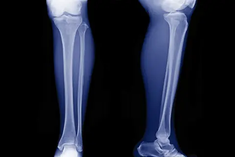 Radiografie delle gambe mostrano un fibroma ossificante, una lesione benigna che coinvolge la tibia e il perone.
