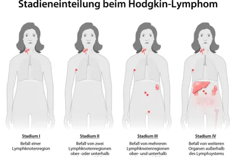 Illustrationen zeigen Stadien des Hodgkin-Lymphoms, von einem einzelnen befallenen Lymphknoten bis zu Befall mehrerer Organe. Symptome Lymphknotenkrebs können sich je nach Stadium ändern.