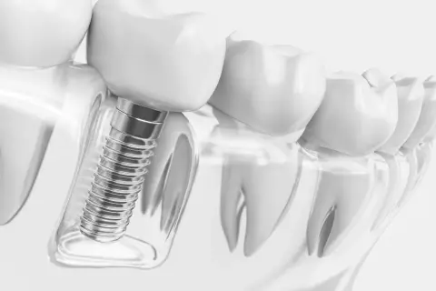 Detalle de implantes dentales tornillos, mostrando su integración en el hueso y la corona dental.