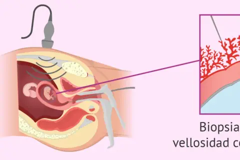 Ilustración de una biopsia corial guiada por ultrasonido, mostrando la toma de muestra de vellosidades coriónicas para análisis genético.