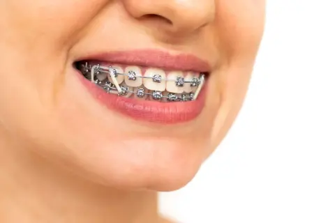 Primo piano di un sorriso con apparecchio ortodontico e elastici, simbolo di un percorso verso denti perfetti.