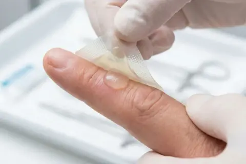 Eine kleine Brandblase am Finger wird vorsichtig mit einem transparenten Verband abgedeckt.