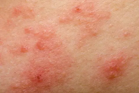 Czy pelargonie uczulają? Objawy alergii i bezpieczne odmiany