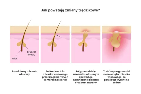 Jak powstaje pryszcz? Poznaj przyczyny i skutki trądziku