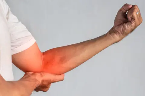 Braccio con tendinite evidenziata in rosso. Forse i rimedi della nonna possono aiutare.