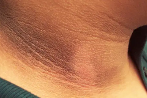 Primer plano de manchas oscuras en el cuello, con la piel arrugada y una textura visible.