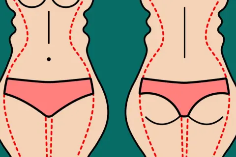 Przed i po liposukcji ultradźwiękowej: zarys sylwetki przed zabiegiem (falisty) i po (gładszy).