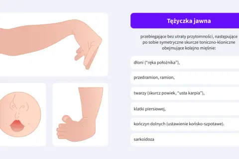 Tężyczka jawna: ilustracje przedstawiające rękę w pozycji "położnika", twarz z wykrzywionymi ustami i stopę.