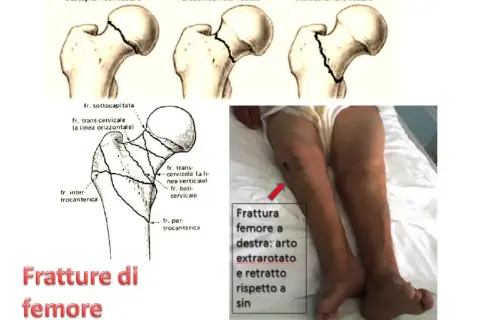Illustrazione tipi frattura femore e gamba con frattura. La prognosi e quanto si vive dopo frattura femore dipendono da molti fattori.