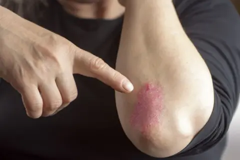 Dłoń wskazuje na łokieć z czerwonymi, suchymi plamami na skórze, które mogą być objawem problemów dermatologicznych.