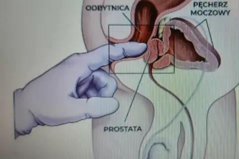 Rękawiczka w ręce wykonuje masaż prostaty, co może prowadzić do orgazmu. Widoczny pęcherz moczowy i odbytnica.