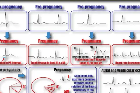 EKG w ciąży: kiedy jest konieczne i co musisz wiedzieć?