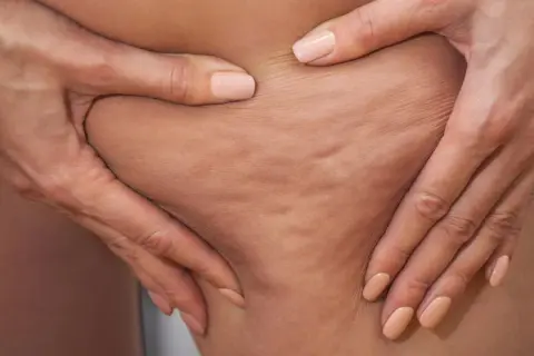 Hände greifen in die Haut und zeigen die typischen Dellen. So entsteht Cellulite.