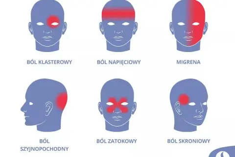 Ilustracja pokazuje różne rodzaje bólu głowy, w tym te spowodowane stresem. Czerwone obszary na głowach symbolizują lokalizację bólu.