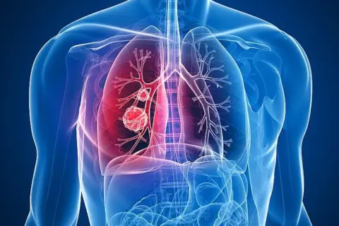 Menschliche Lunge mit einem roten Tumor, der Lungenkrebs darstellt. Das Alter spielt eine Rolle bei der Entstehung.