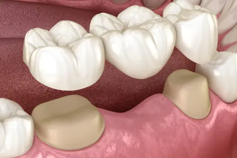 Most porcelanowy na podbudowie metalowej, uzupełniający braki w uzębieniu.