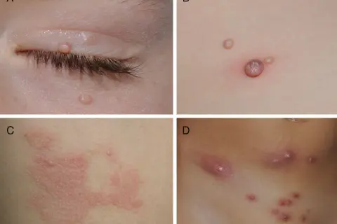 Lesiones de molusco contagioso en la piel de niños. A: párpado. B: tronco. C: tronco con inflamación. D: abdomen.