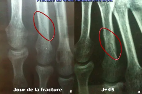 Radiographie du pied montrant une fracture du 4ème métatarsien droit, jour de la fracture et J+45. La guérison prend du temps.